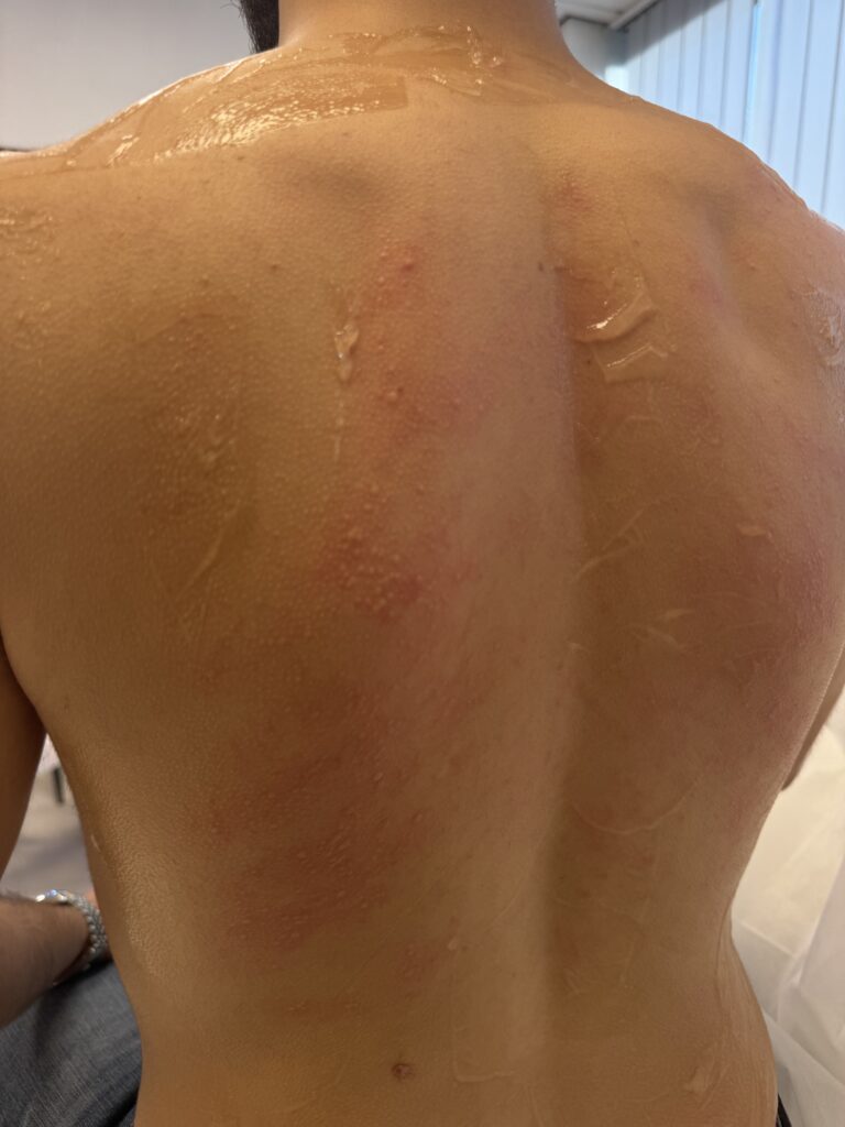 Rug van een man direct na laserontharing, met lichte roodheid en gel op de huid